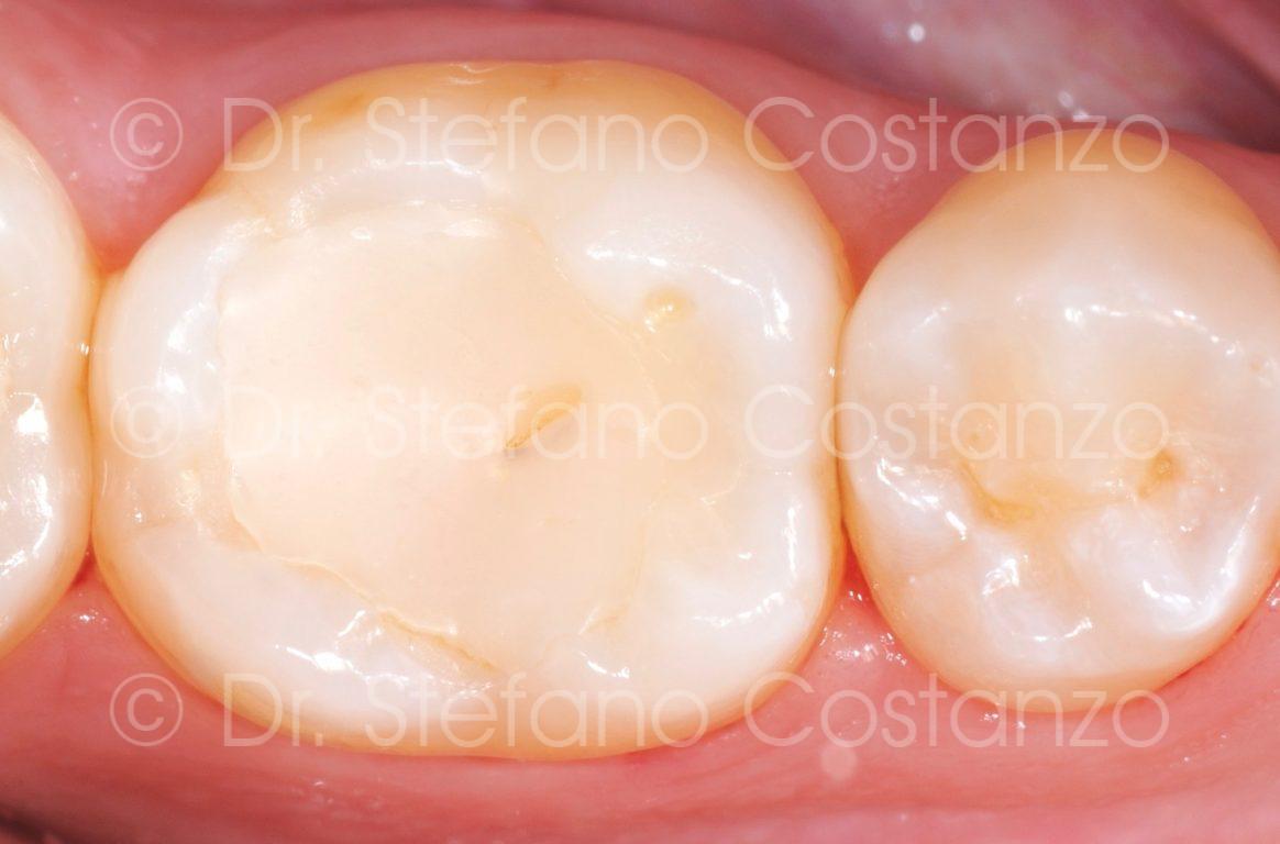 Intarsio in ceramica CAD-CAM