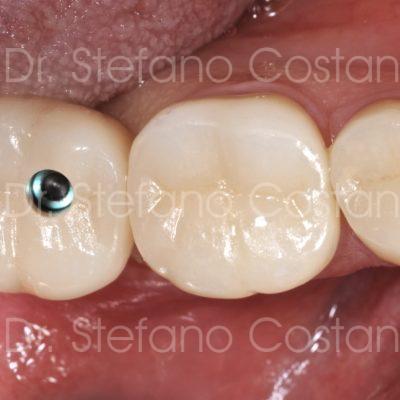 Riabilitazioni estetiche CAD-CAM