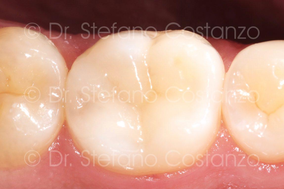 Intarsio in ceramica CAD-CAM