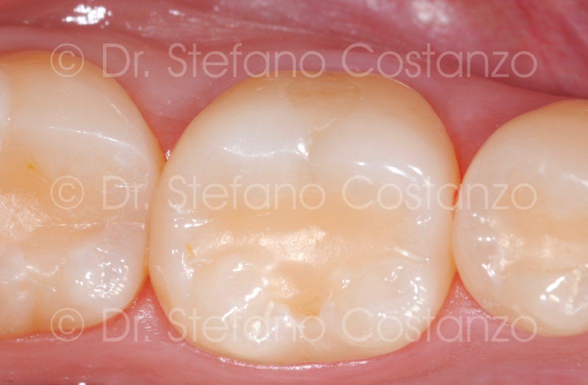 Intarsio in ceramica CAD-CAM