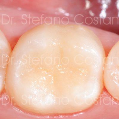 Intarsio in ceramica CAD-CAM