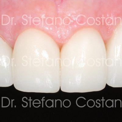 Riabilitazioni estetiche CAD-CAM